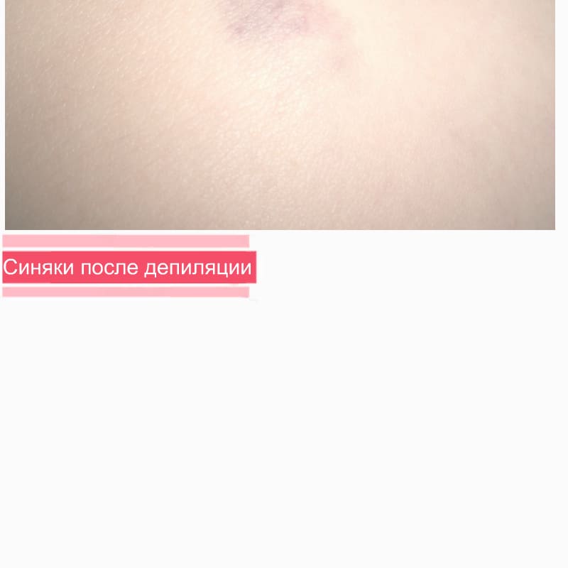 Синяки после шугаринга