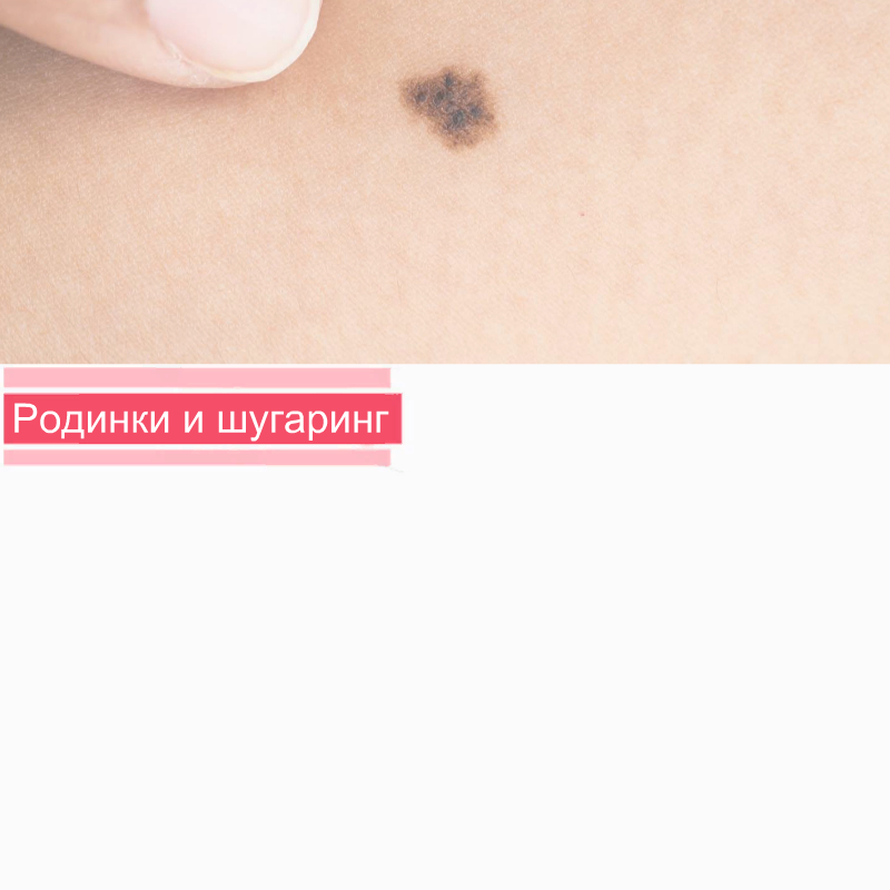 Родинки и шугаринг