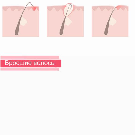 Как бороться с вросшими волосами?
